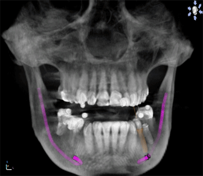 Current Dental Implant Options