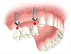 Replacing several missing Teeth