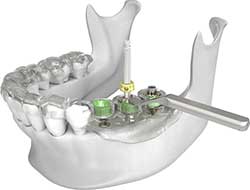 Teeth in A Day Dental Implants