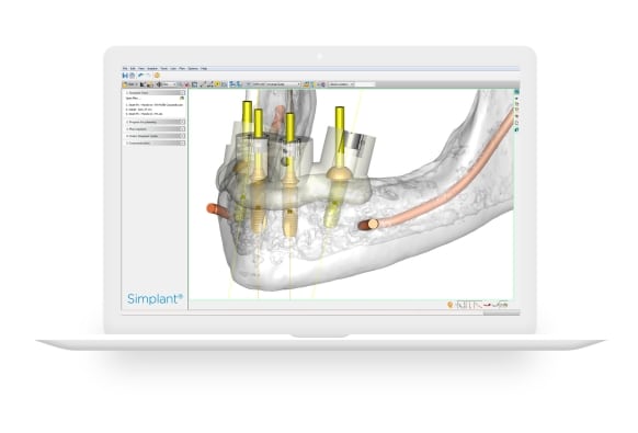 Virtual Dental Implants Surgery