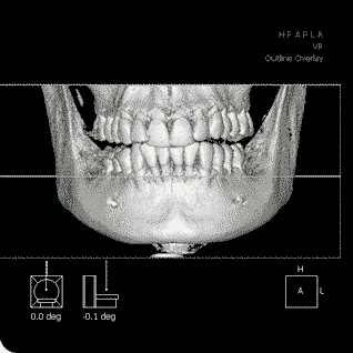 Virtual Dental Implants