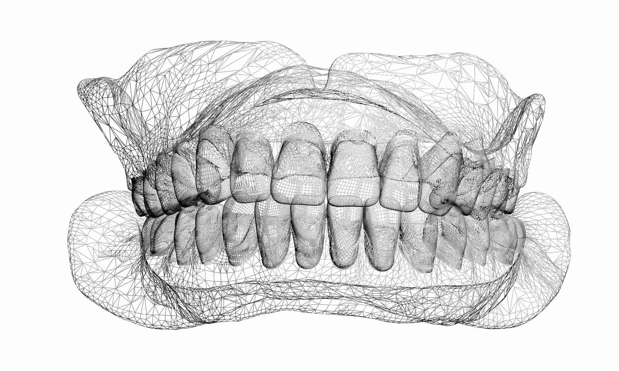 Dental Splinting Non Invasive Treatment for Loose Teeth