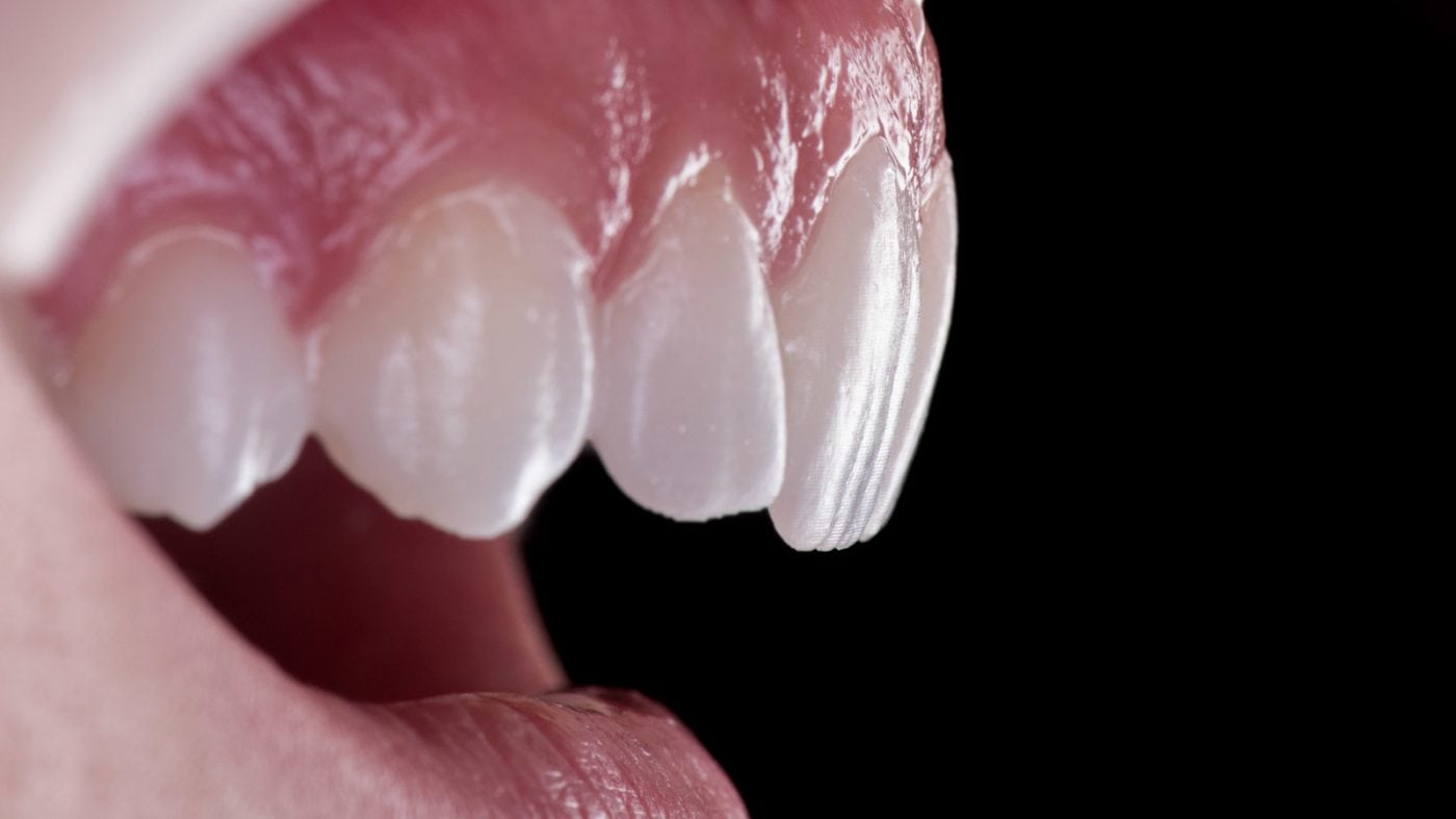 Dentures Cost - Lane Ends Dental Practice