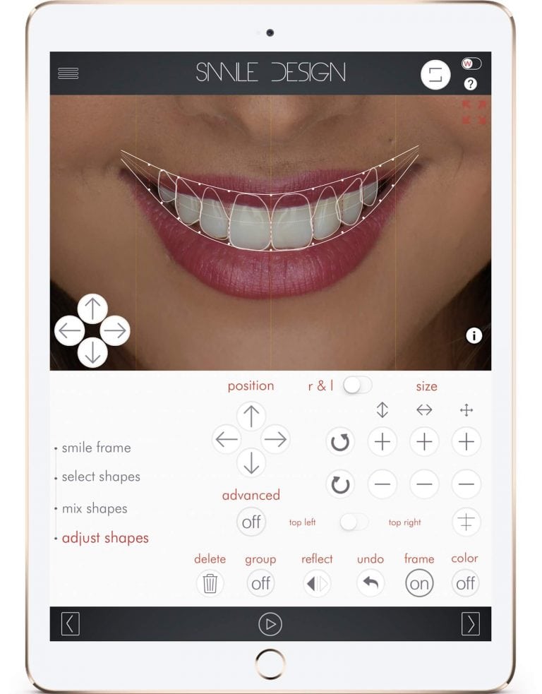 smile digital veneers dental makeover options software porcelain teeth advances cosmetic proportion preston matter minutes ideal bring lip very patient