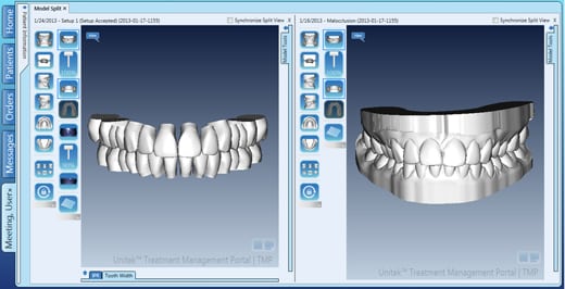 Worn Teeth Solution