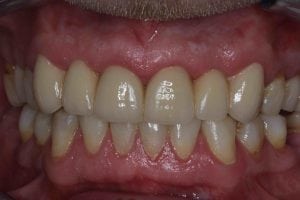 ceramic dental bridge after photos