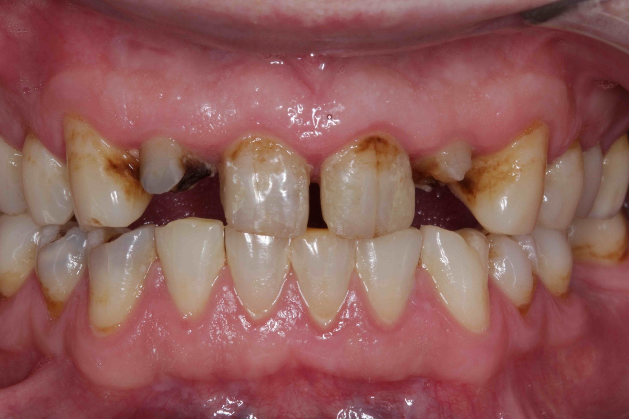 upper Dental bridges before after pictures - Broken down Teeth Treatment