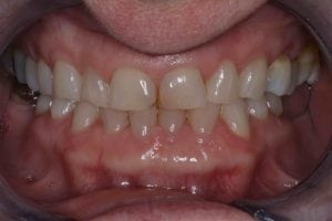 Broken Down Teeth treatment before after pictures