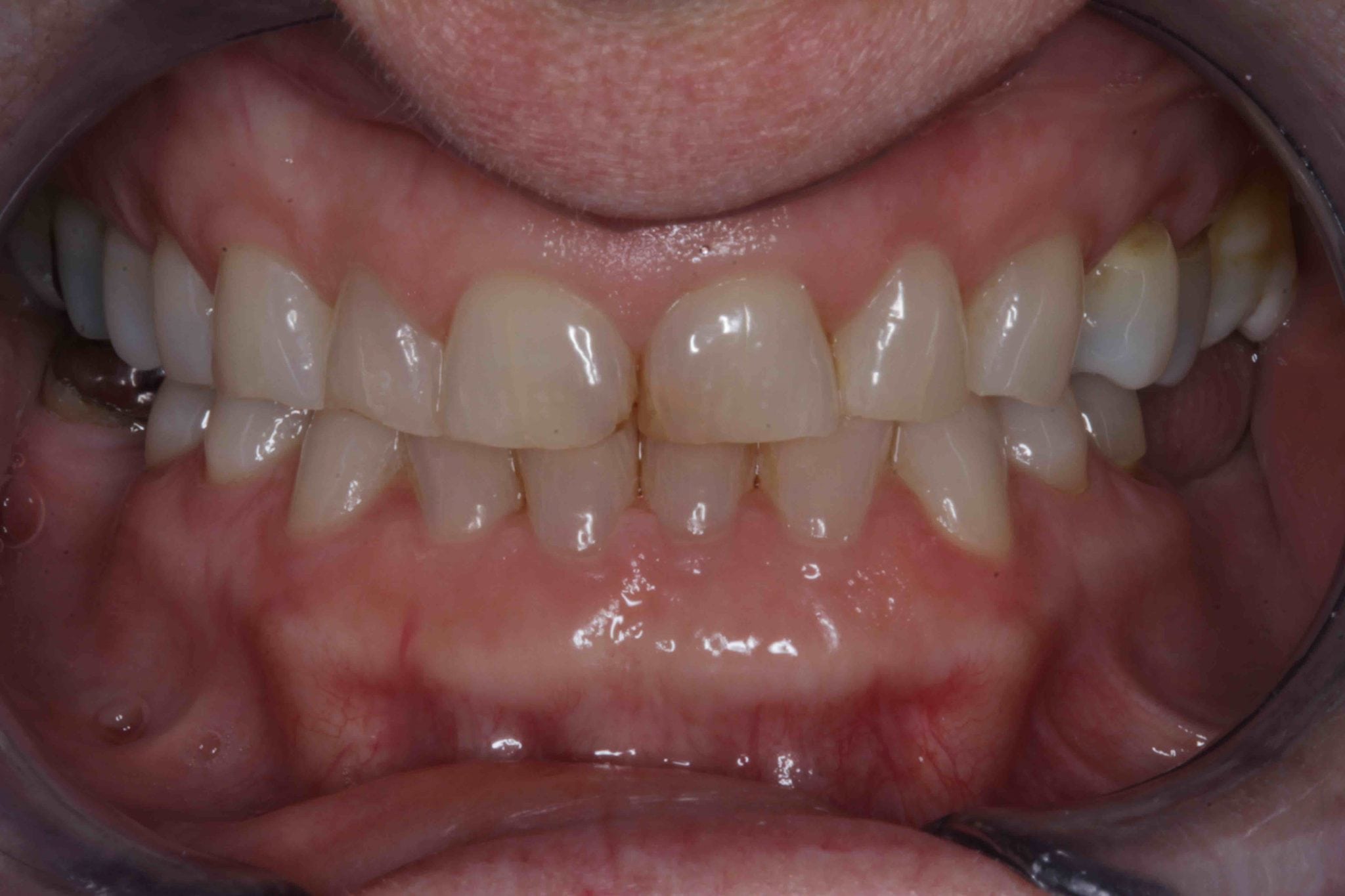 Broken Teeth Before after photos - Before Treatment