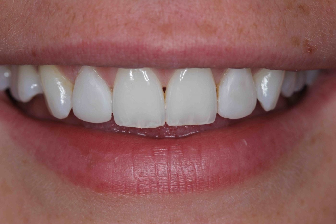 Before and After Dental Bonding Photos | Cosmetic Bonding Dentists