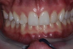 Dental Bonding on Front teeth