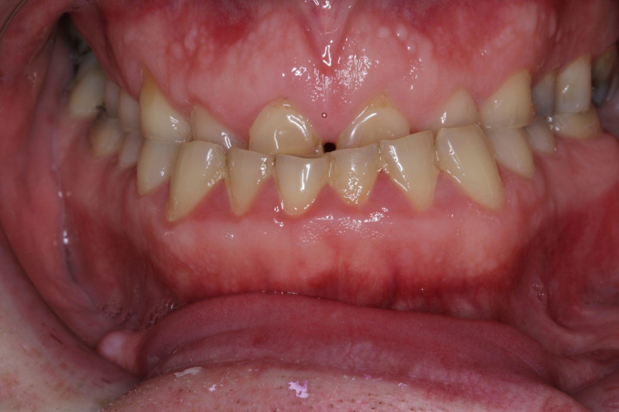 smile makeover of severely worn down teeth