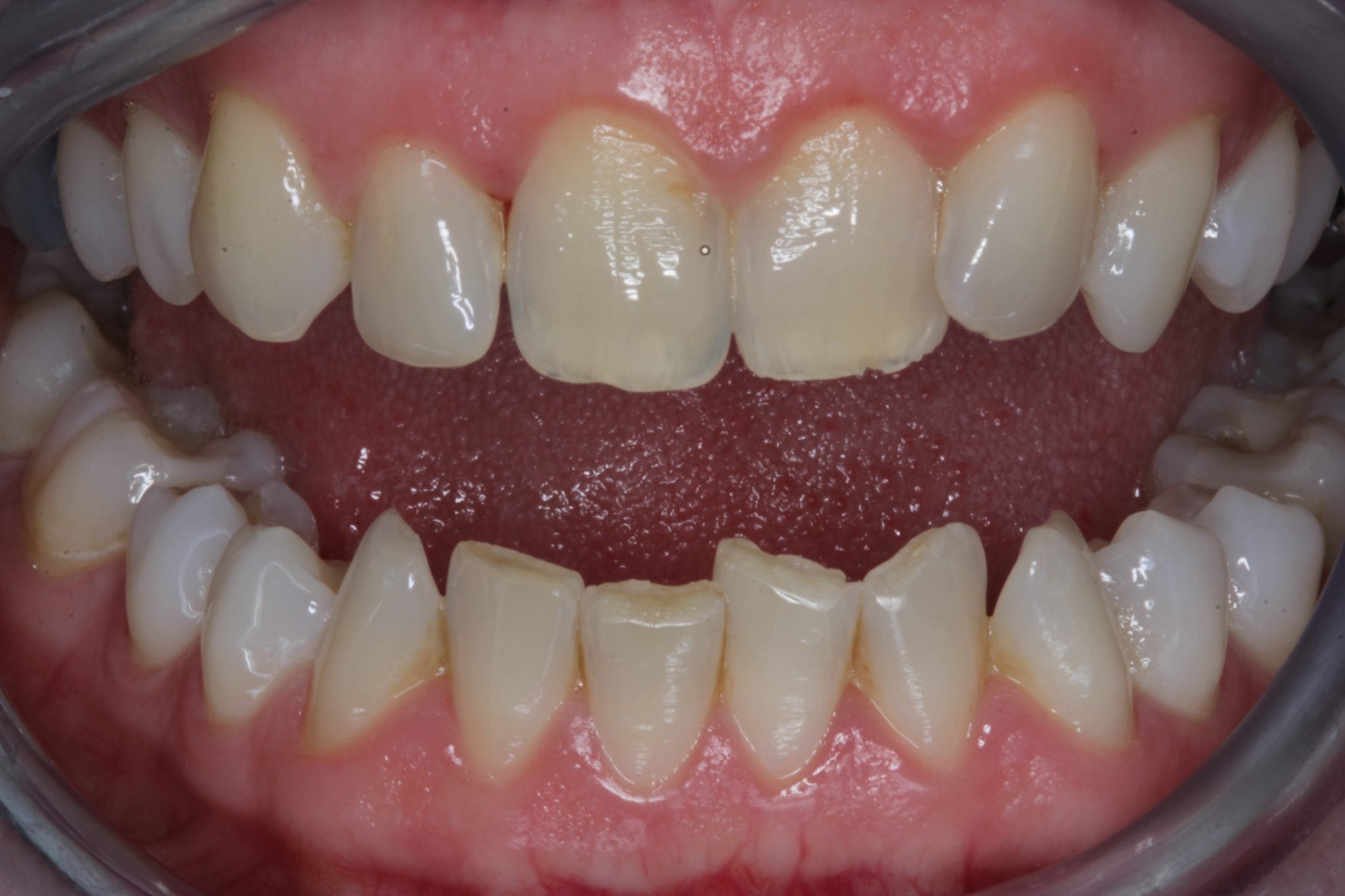 upper incisors restored with porcelain veneers - Before