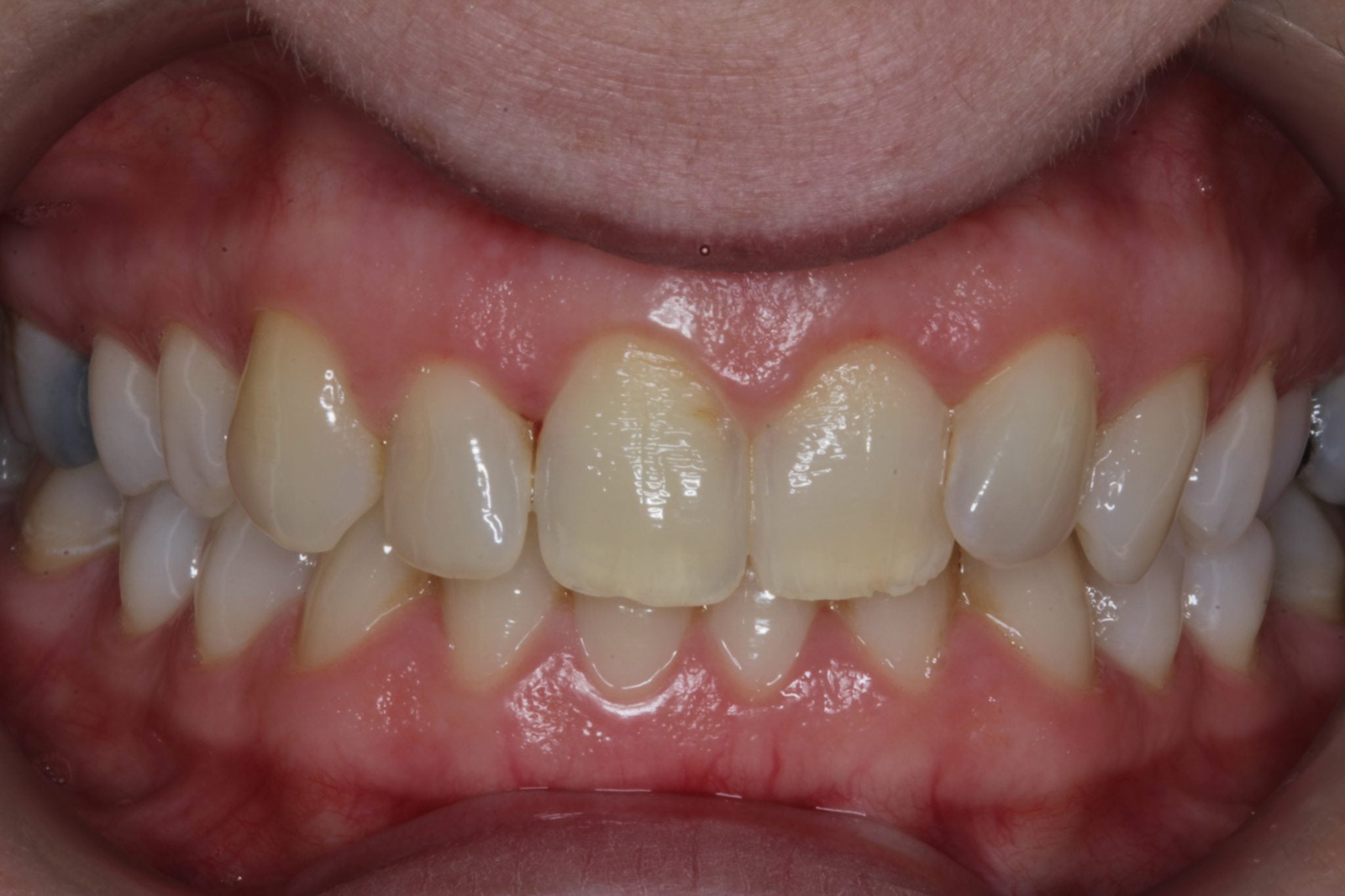 Smile Makeover with Dental Bonding - Before