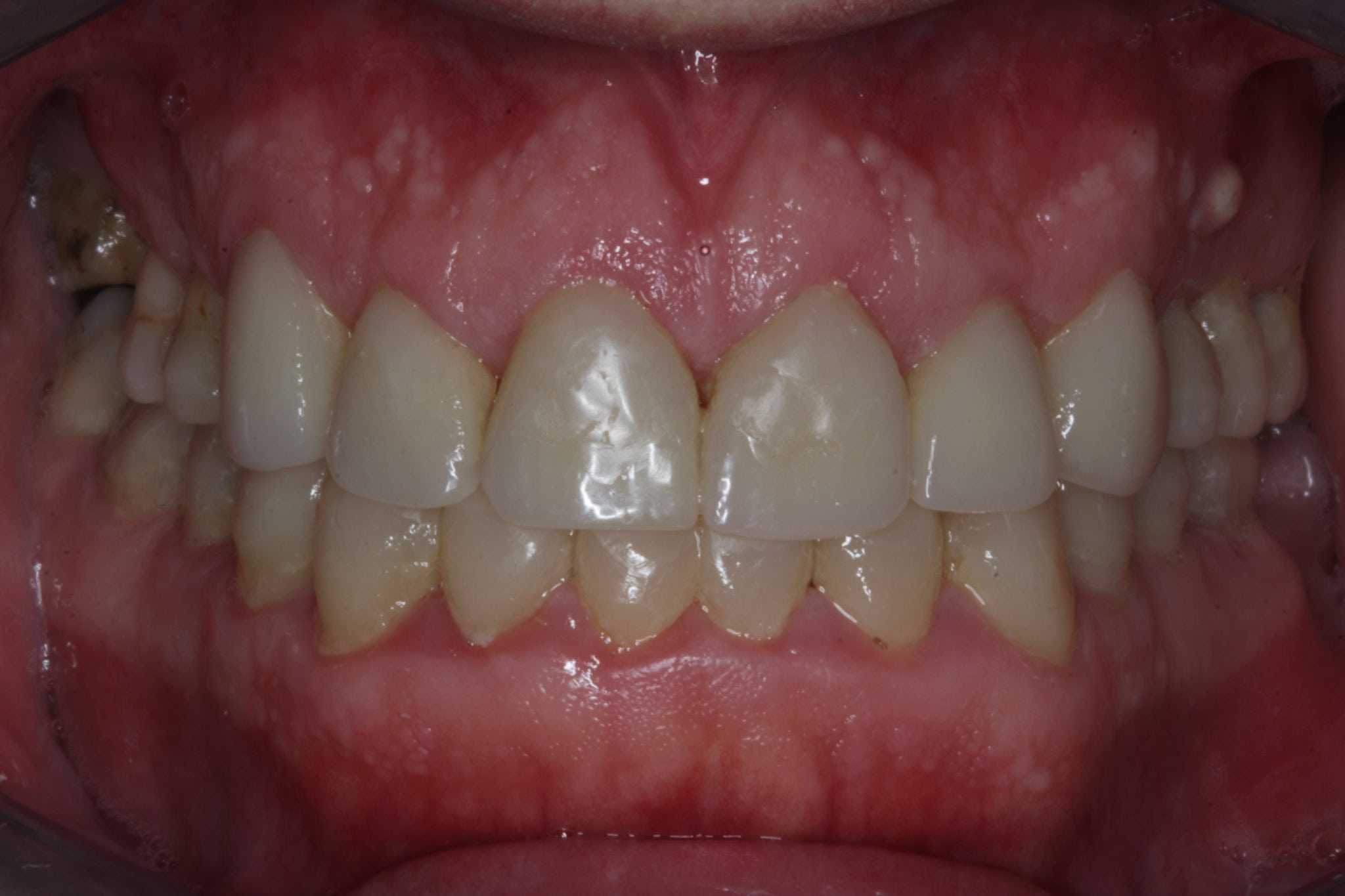 dental bonding makeover - after images