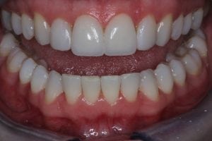 Cosmetic Bonding lower teeth - After