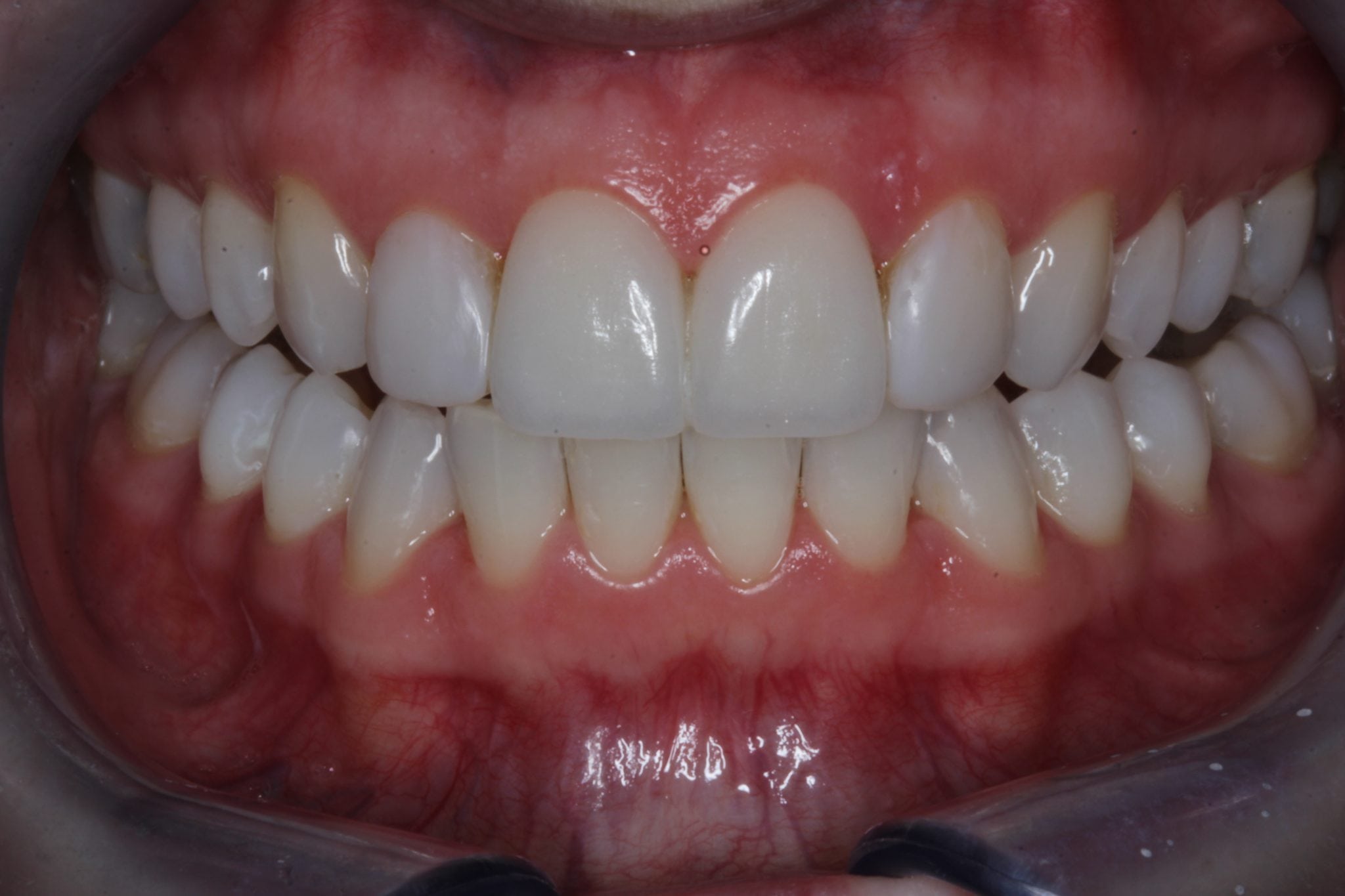 Porcelasin veneers and Dental bonding - after image