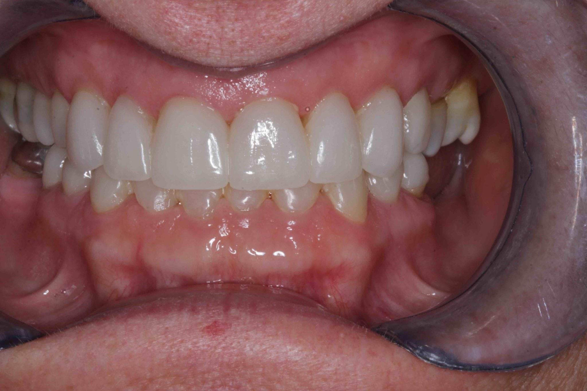 Broken Teeth Before after photos - After Treatment