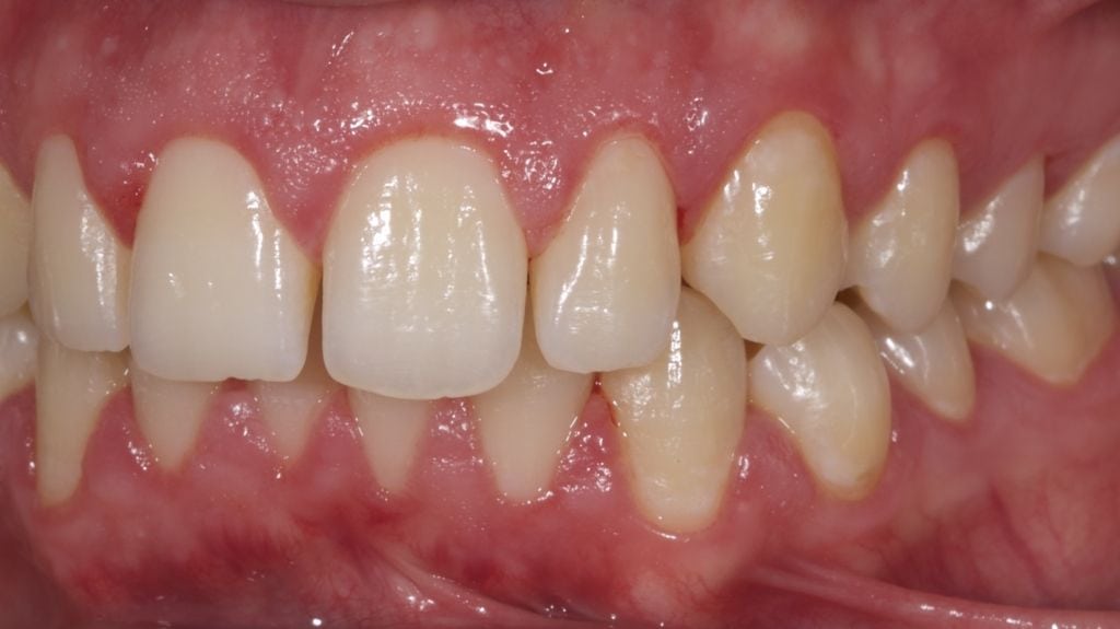 Can Fillings Look Like Your Natural Teeth? - TruCare Dentistry