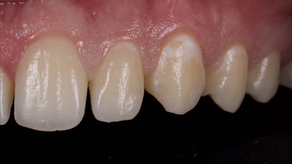 White Fillings Before and After photos - Front Tooth Composite Fillings