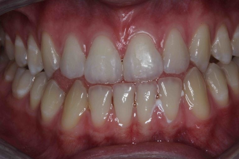 teeth translucent s