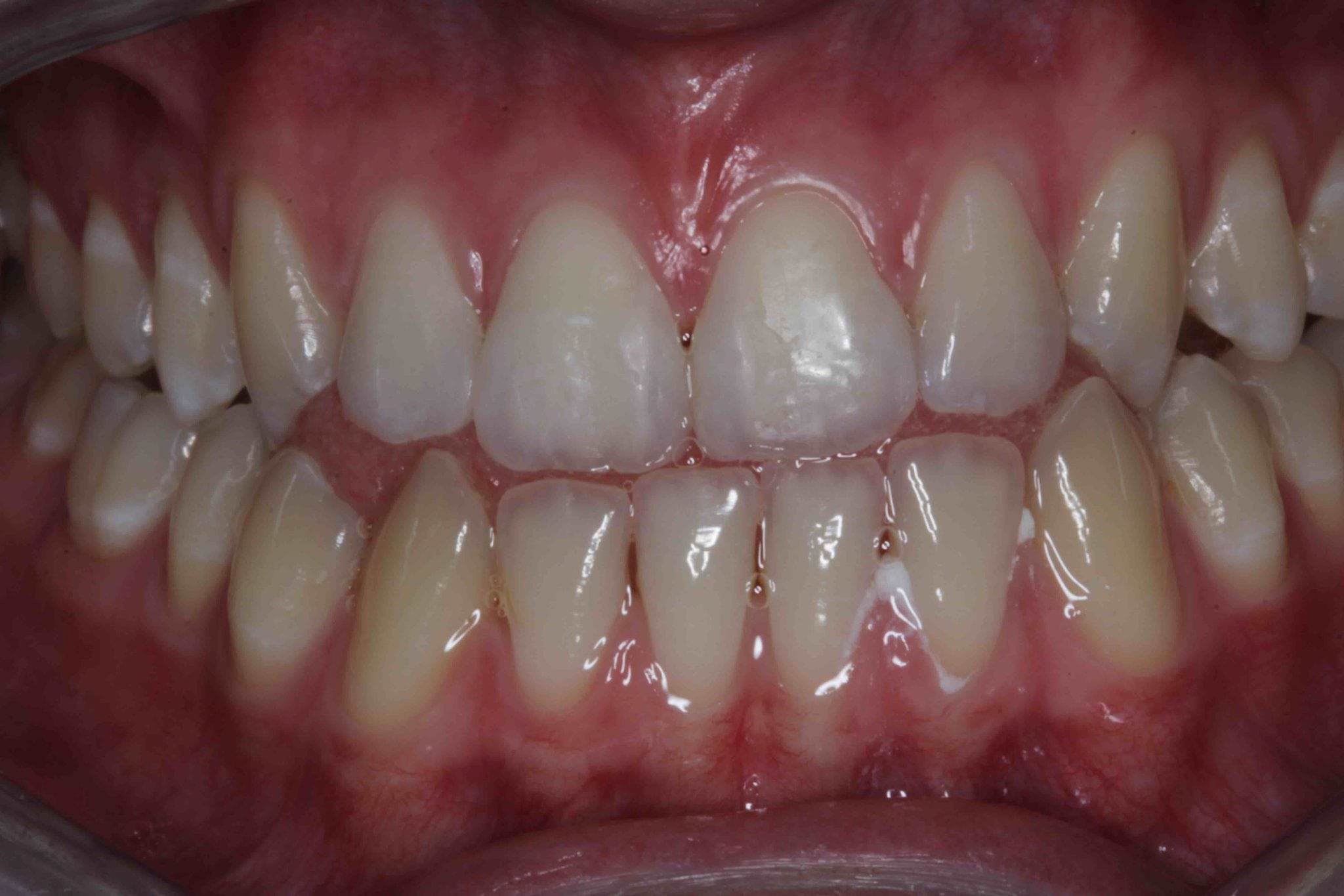 cavities between front teeth