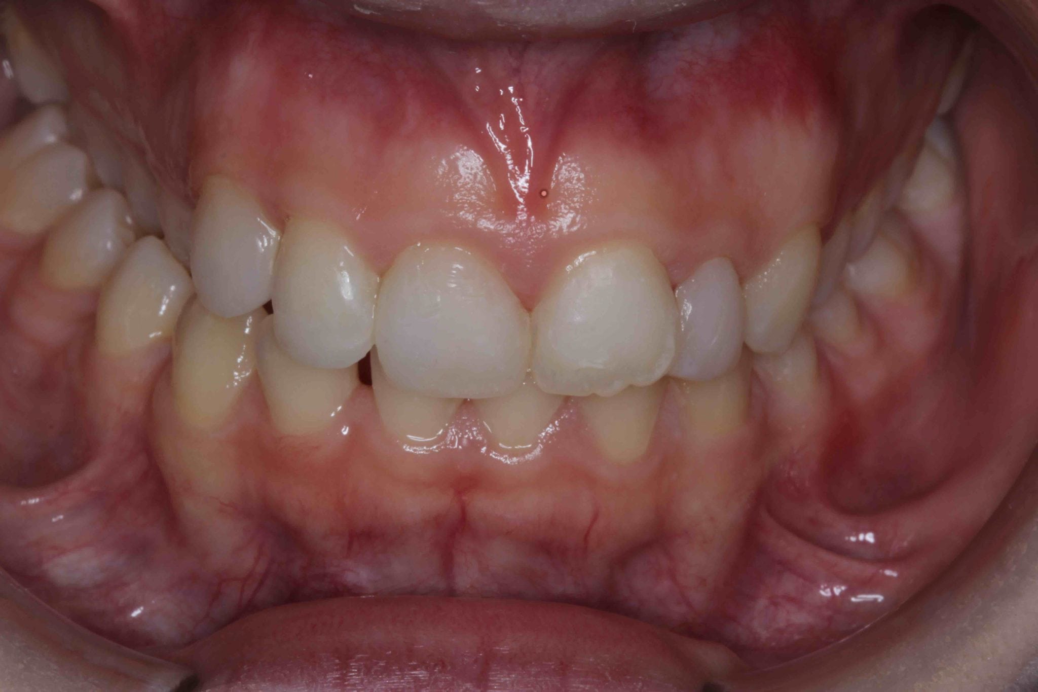 Tooth coloured Filling After Treatment Picture