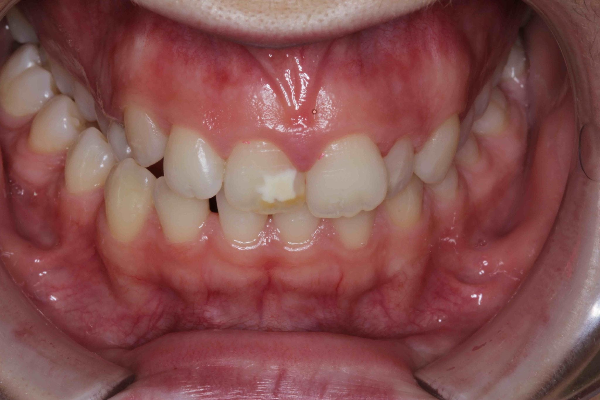 White Patch on Front Tooth before Tooth Coloured Fillings photos