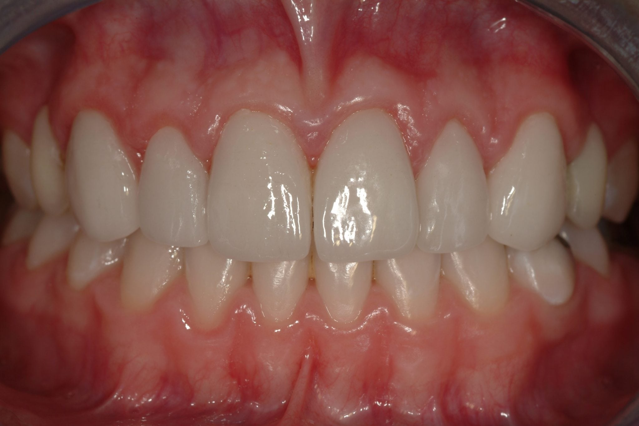 crown lengthening after photos