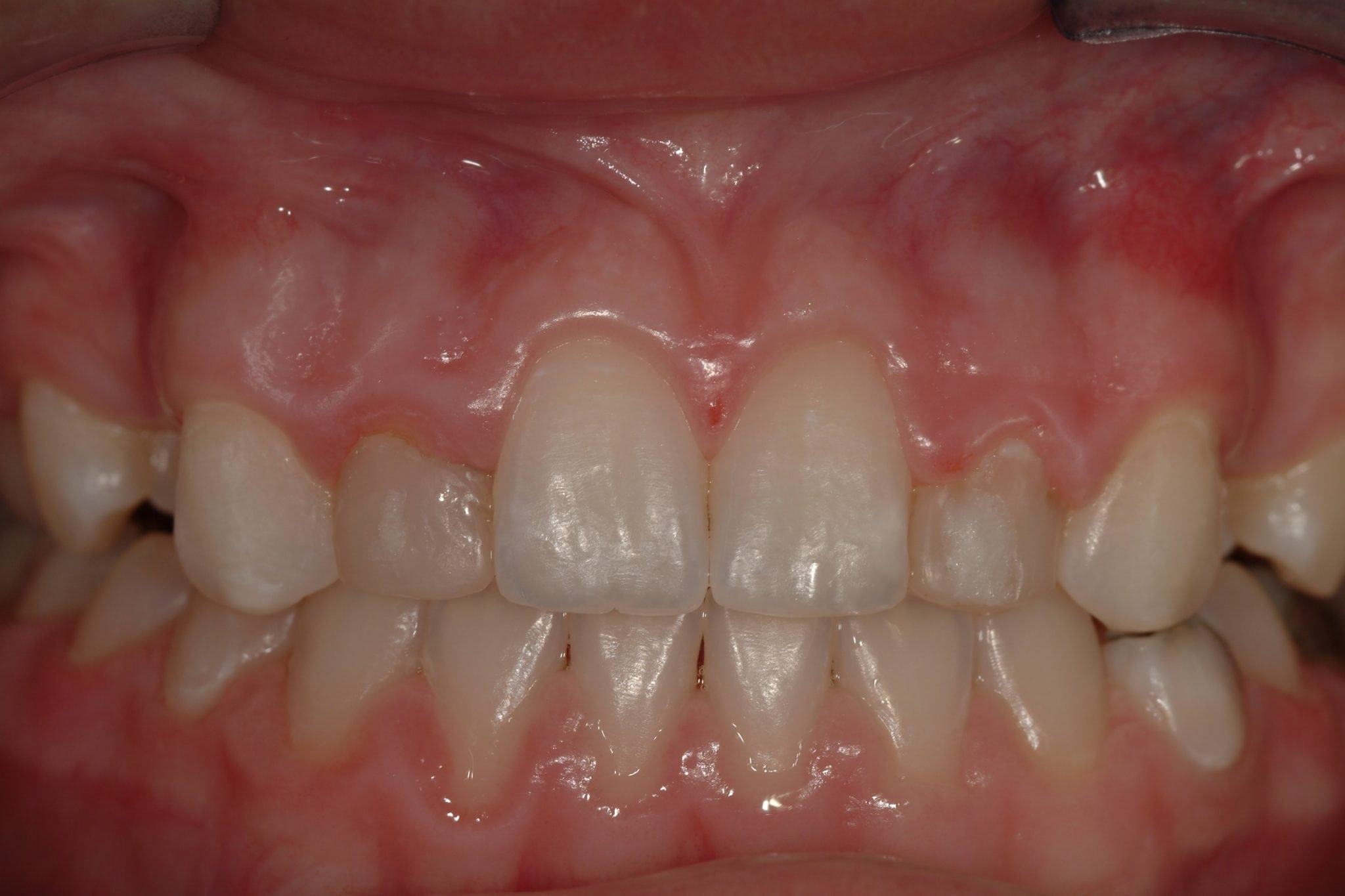 Cosmetic Dental crowns Before treatment