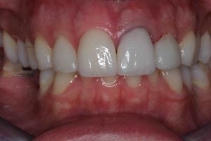 dark black tooth crowned after photos