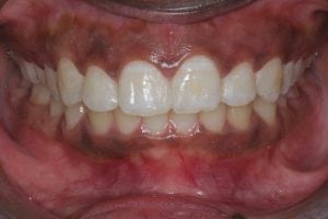 Front Teeth Gaps closed with dental Bonding - after photo