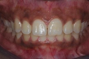 Cosmetic Bonding closing gap between front teeth - before treatment photo