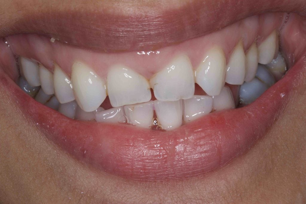 Before And After Dental Bonding Photos Cosmetic Bonding Dentists 9092