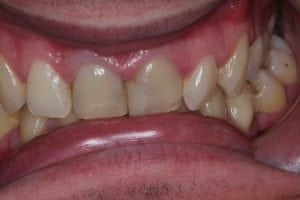 dental crowns before treatment photos