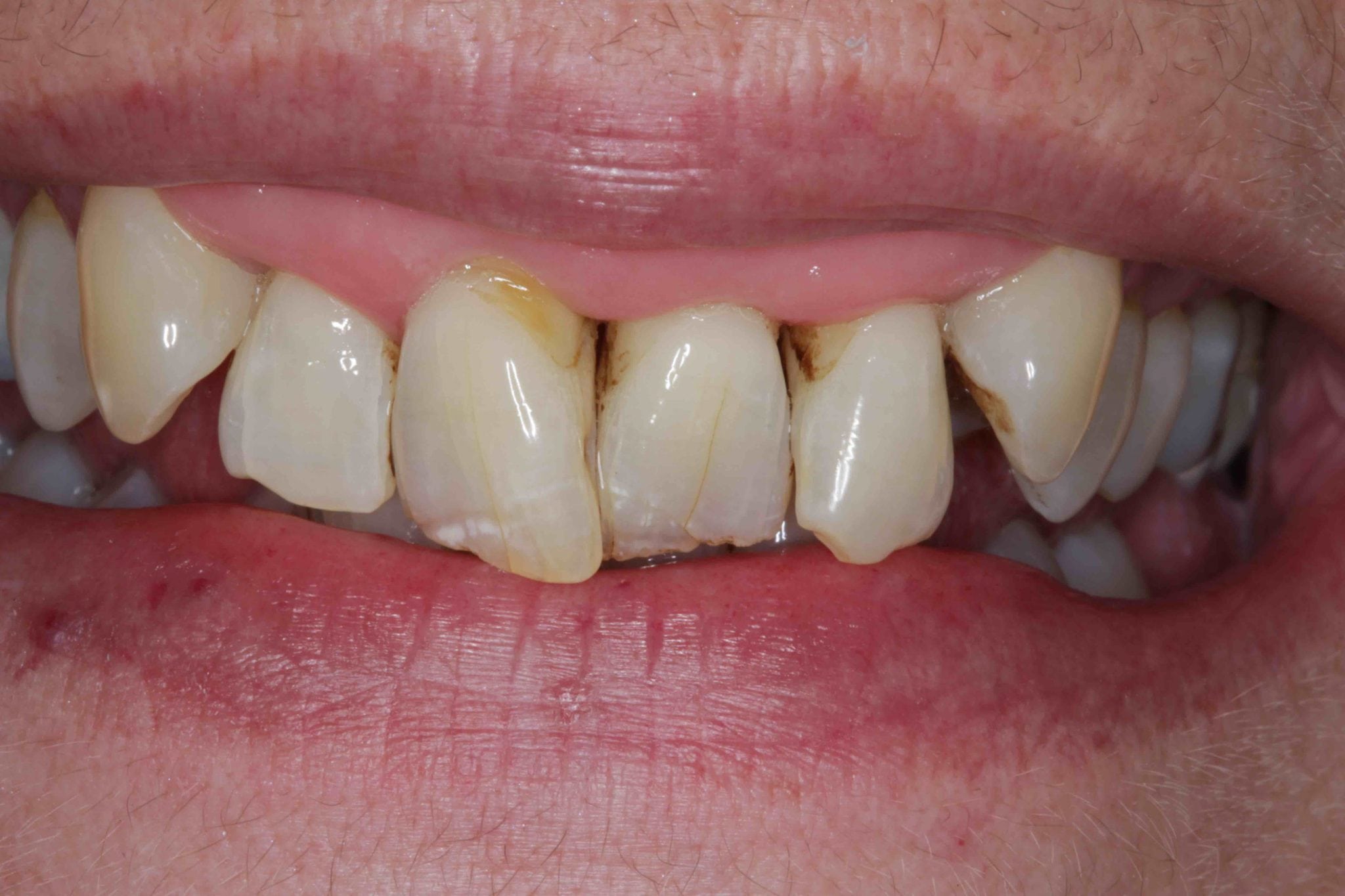 smile makeover before after - dental crowns