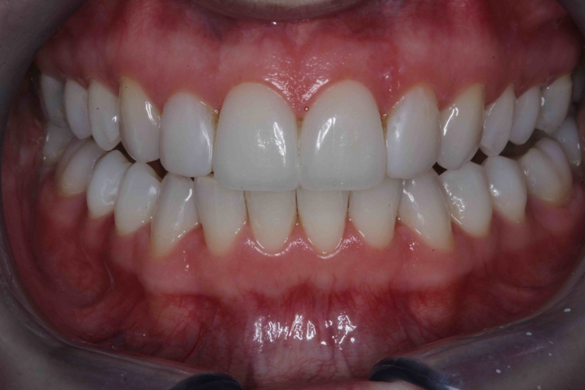 Porcelain Veneers before and after Smile makeover photos