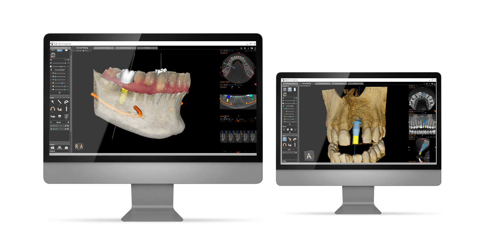 Smile make over option - Dental Implants