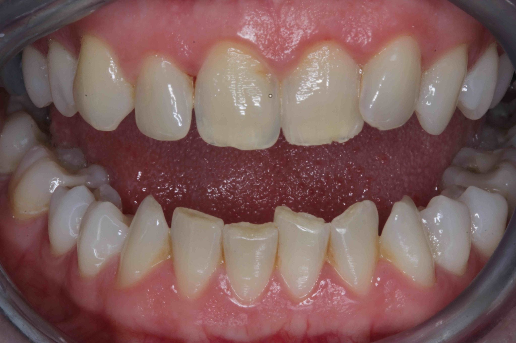 Before & After Porcelain Veneers Pictures - Cosmetic Dentists in Preston