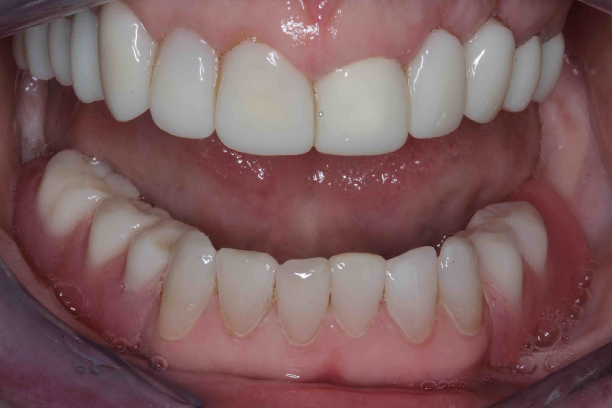 Smile make over after treatment photo