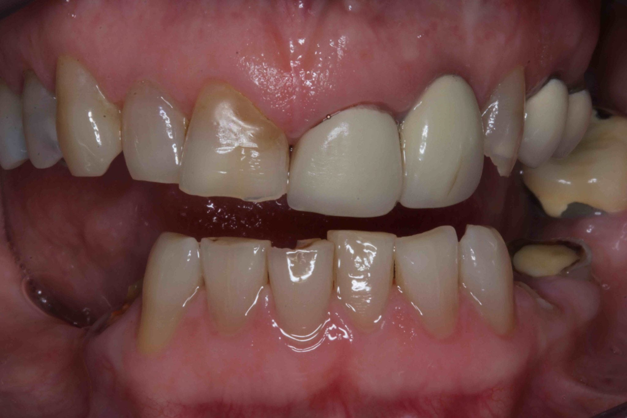 Smile Makeover Before After Gallery - Cosmetic dentists in Lancashire