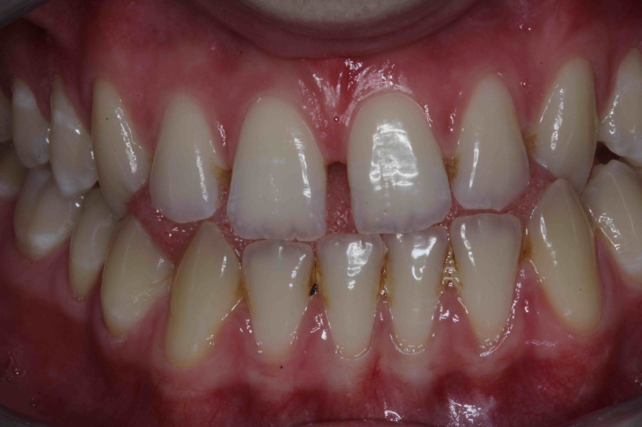 gray between front teeth calculus