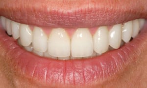 Gummy smile before and After photos - Preston Dentist