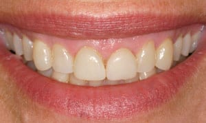 gummy smile before and after images