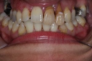 Front teeth bridge before after photos