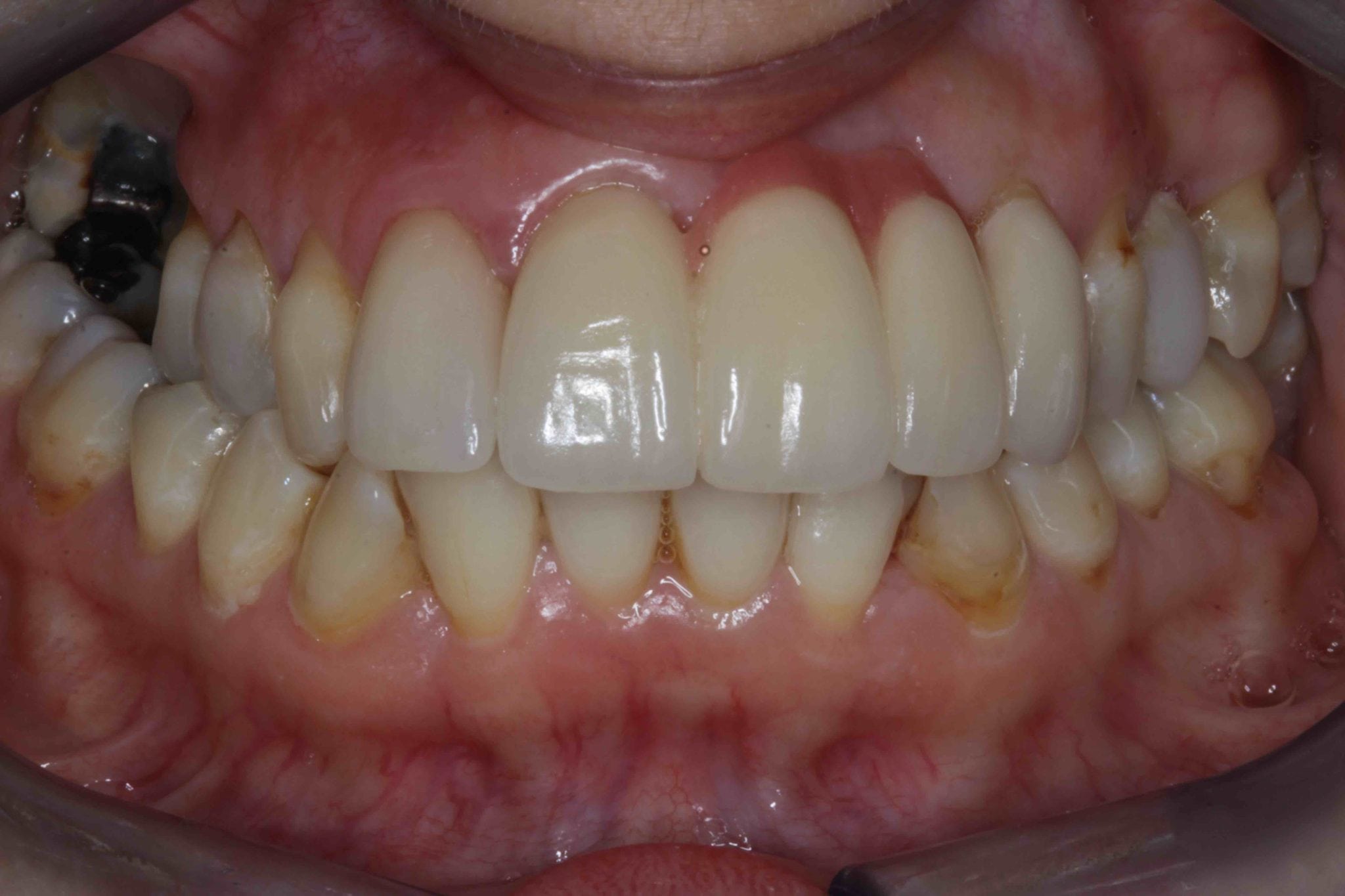 Smile Makeover before after - Upper dental Bridge gallery