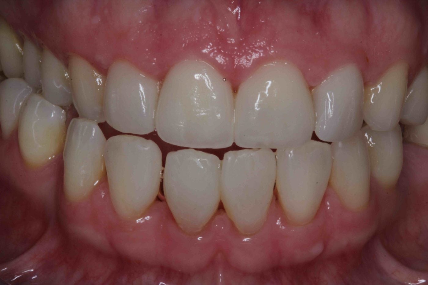 severe translucent teeth