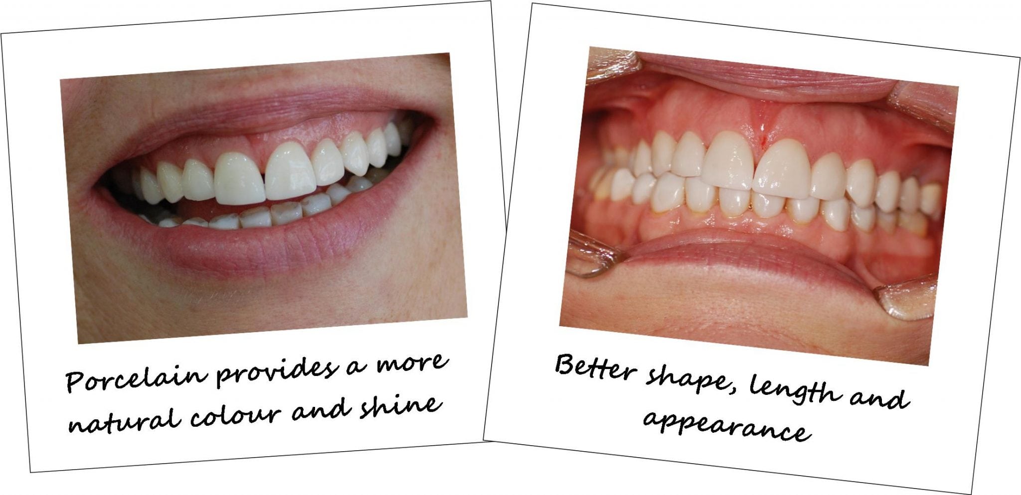 Cosmetic tooth veneers before and after photos