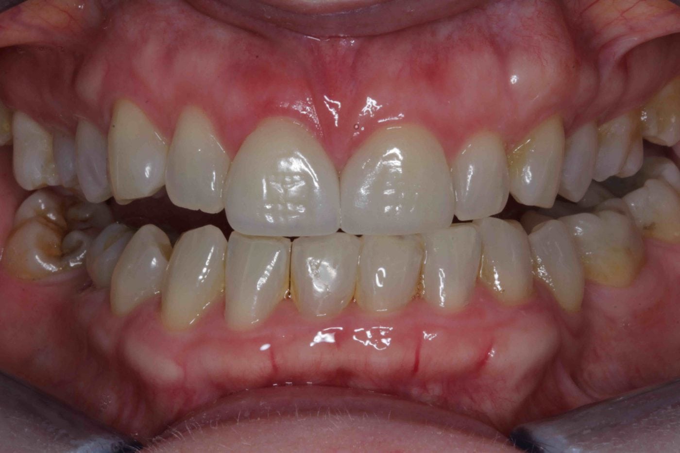 translucent teeth