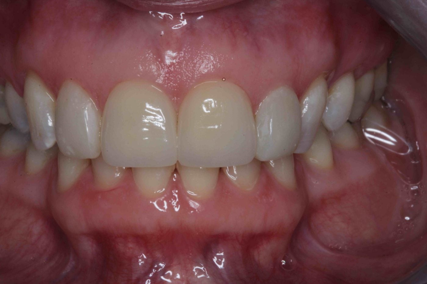 Before and After Dental Bonding Photos Cosmetic Bonding Dentists